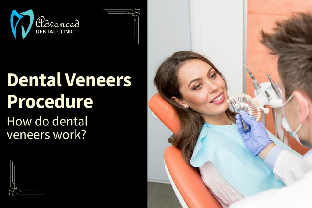 Step by step guide – How Do Dental Veneers Work